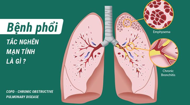 Bệnh phổi tắc nghẽn mạn tính COPD có tương quan với các bệnh khác không?