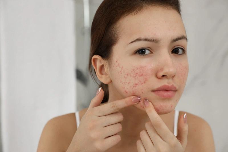 Hậu quả của mụn để lại khiến da trông thật tổn hại
