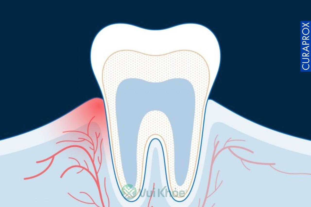 Viêm nhiễm khiến cơ thể tăng số lượng mạch máu và làm tăng thể tích tổng thể của mô.